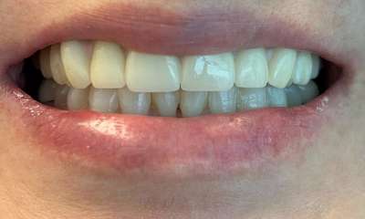 Fixed-Denture-All-On-4-After-Image