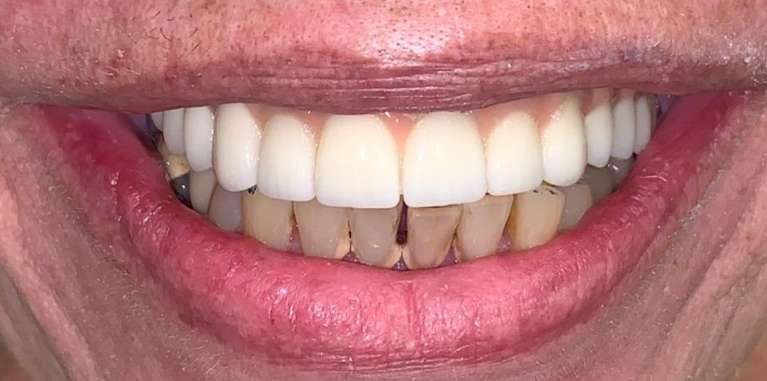Fixed-Dentures-All-on-4-After-Image