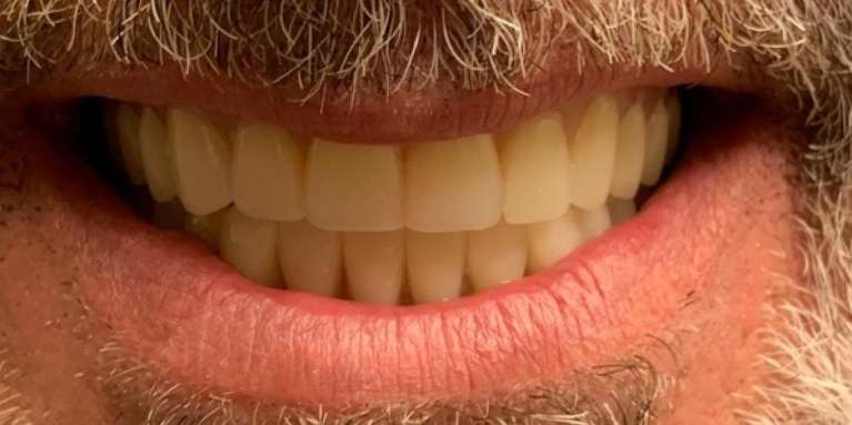 Implant-Retained-Dentures-After-Image