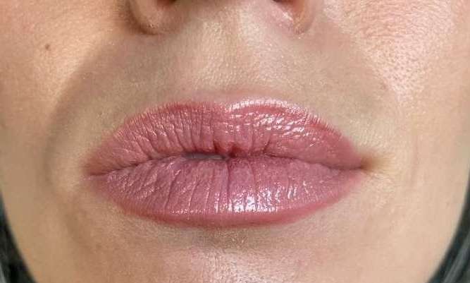 Lip-Flip-Xeomin-After-Image