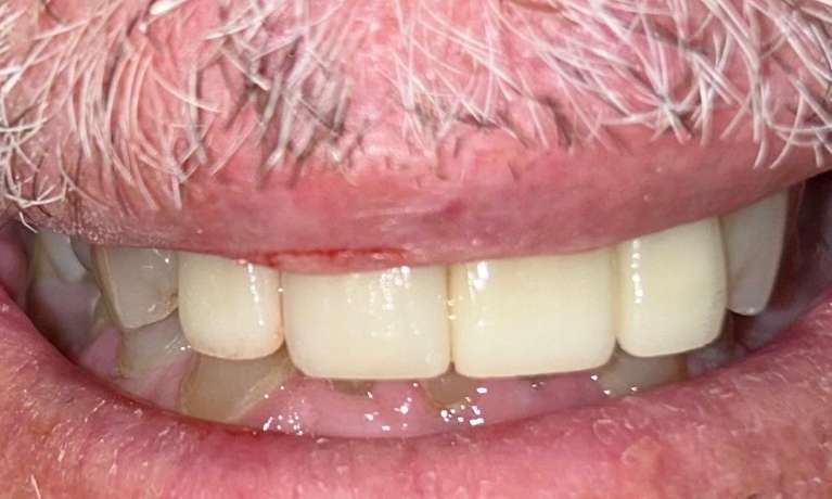 Crowns-After-Image