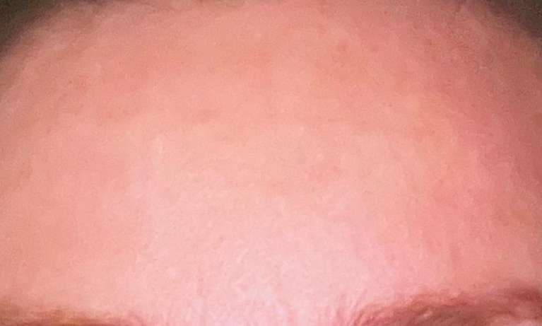 Forehead-Xeomin-After-Image