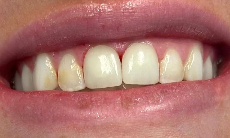 Emergency-Fractures-to-Crowns-After-Image