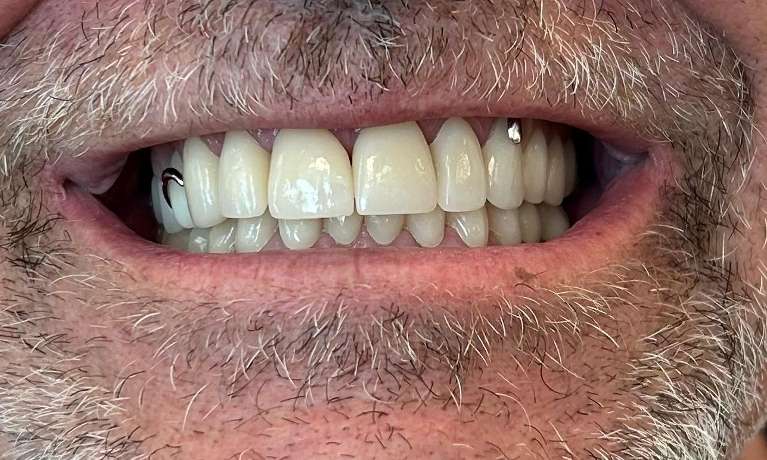 Crowns-and-Removable-Partial-Denture-After-Image