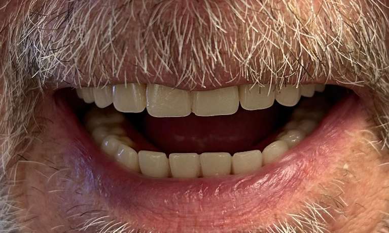 Dentures-After-Image