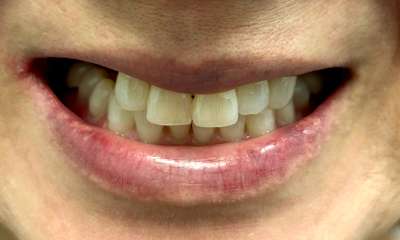 Fixed-Denture-All-On-4-Before-Image