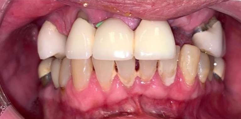 Fixed-Dentures-All-on-4-Before-Image