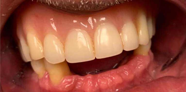 Implant-Retained-Dentures-Before-Image