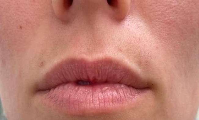 Lip-Flip-Xeomin-Before-Image