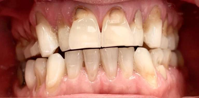 Crowns-Before-Image