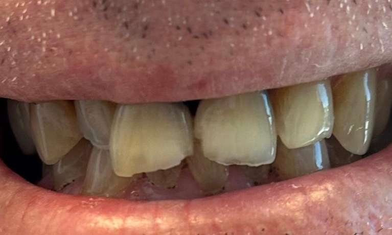 Crowns-Before-Image