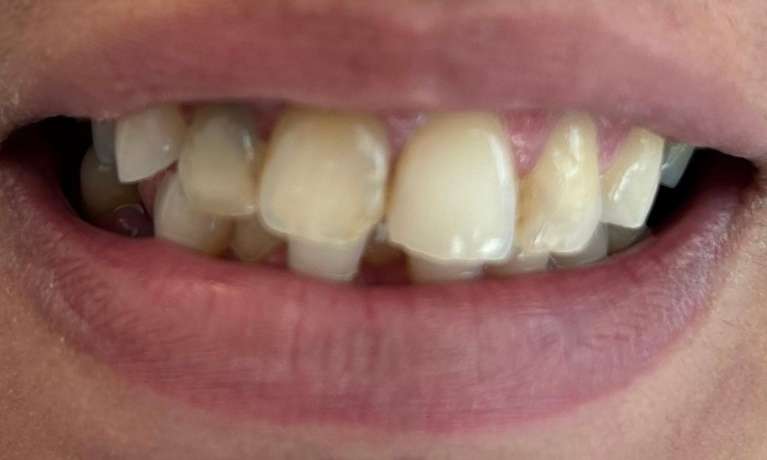 Crowns-Before-Image
