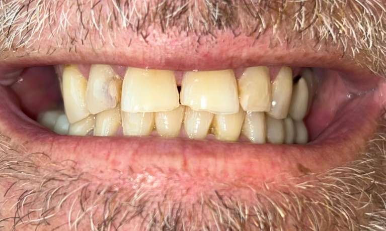 Crowns-and-Removable-Partial-Denture-Before-Image