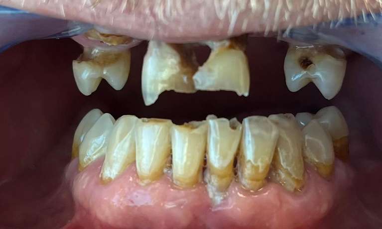 Dentures-Before-Image